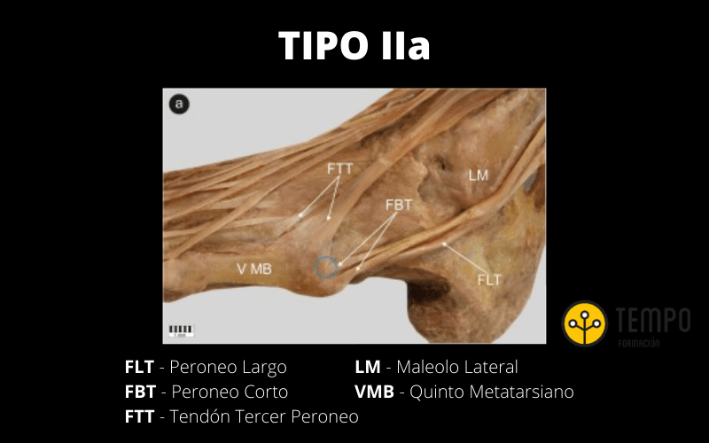 Tipo IIa.png